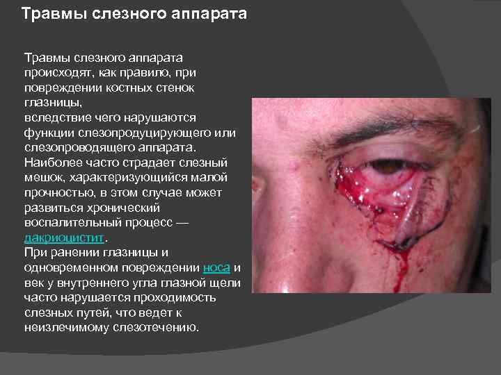 Травмы слезного аппарата происходят, как правило, при повреждении костных стенок глазницы, вследствие чего нарушаются