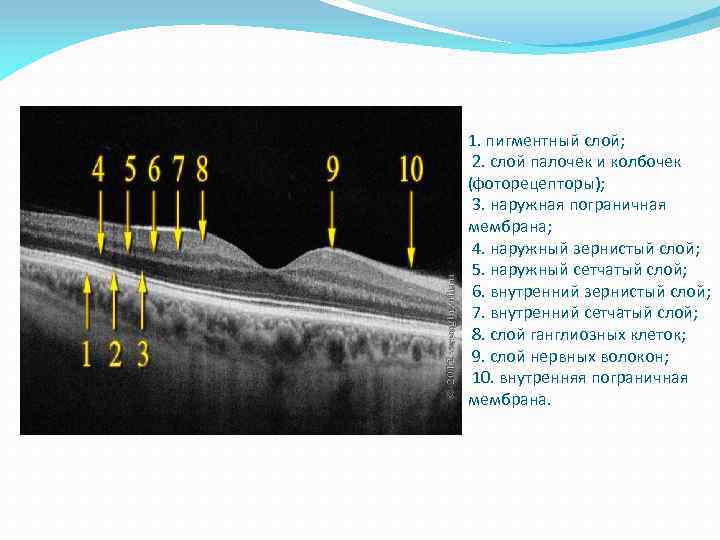 1. пигментный слой; 2. слой палочек и колбочек (фоторецепторы); 3. наружная пограничная мембрана; 4.