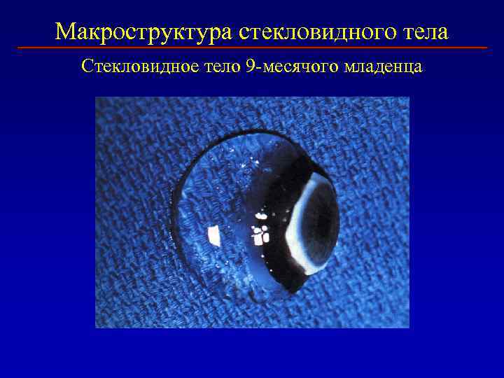Макроструктура стекловидного тела Стекловидное тело 9 -месячого младенца 