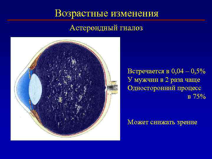 Возрастные изменения Астероидный гиалоз Встречается в 0, 04 – 0, 5% У мужчин в