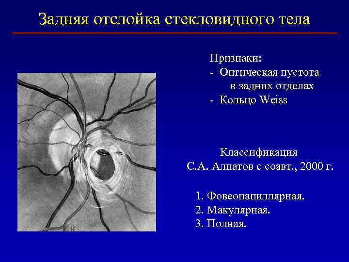 Задняя отслойка стекловидного тела Признаки: - Оптическая пустота в задних отделах - Кольцо Weiss