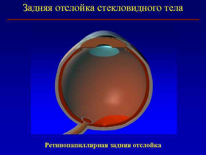Задняя отслойка стекловидного тела Ретинопапиллярная задняя отслойка 