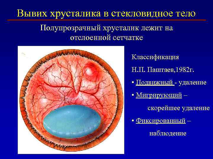 Вывих хрусталика в стекловидное тело Полупрозрачный хрусталик лежит на отслоенной сетчатке Классификация Н. П.