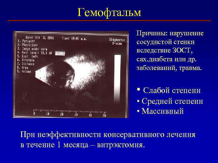 Гемофтальм Причины: нарушение сосудистой стенки вследствие ЗОСТ, сах. диабета или др. заболеваний, травма. •