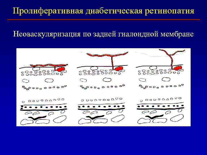 Пролиферативная диабетическая ретинопатия Неоваскуляризация по задней гиалоидной мембране 
