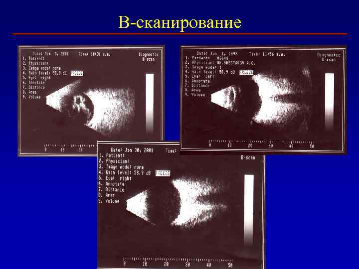 В-сканирование 