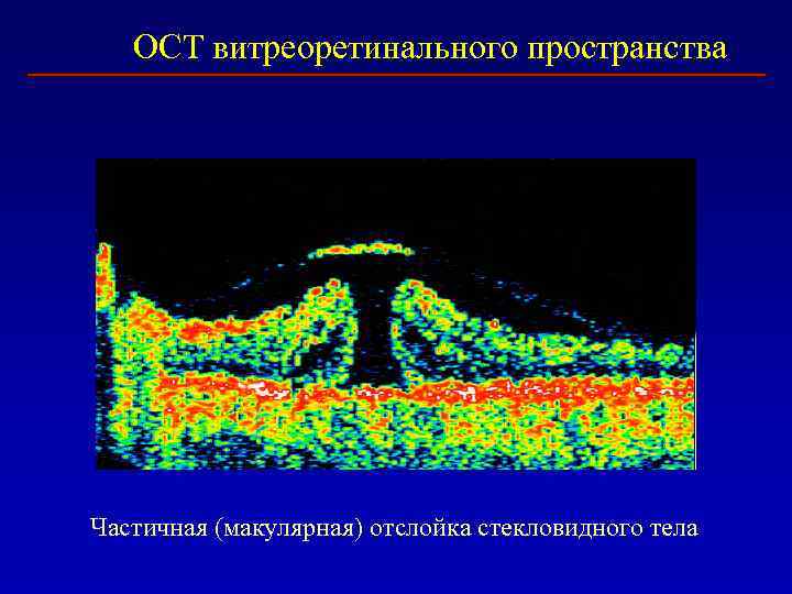 ОСТ витреоретинального пространства Частичная (макулярная) отслойка стекловидного тела 