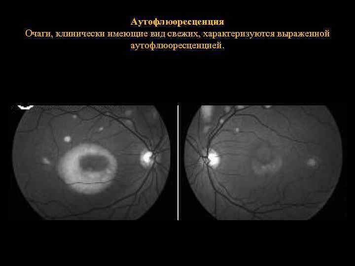 Аутофлюоресценция Очаги, клинически имеющие вид свежих, характеризуются выраженной аутофлюоресценцией. 