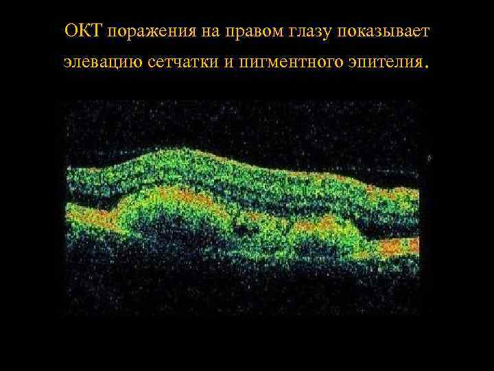 ОКТ поражения на правом глазу показывает элевацию сетчатки и пигментного эпителия. 
