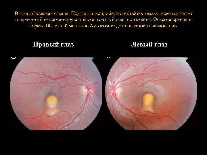 Вителлиформная стадия. Под сетчаткой, обычно на обоих глазах. имеется четко очерченный непроминирующий желтоватый очаг