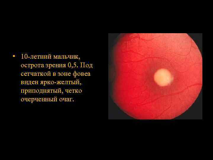  • 10 -летний мальчик, острота зрения 0, 5. Под сетчаткой в зоне фовеа