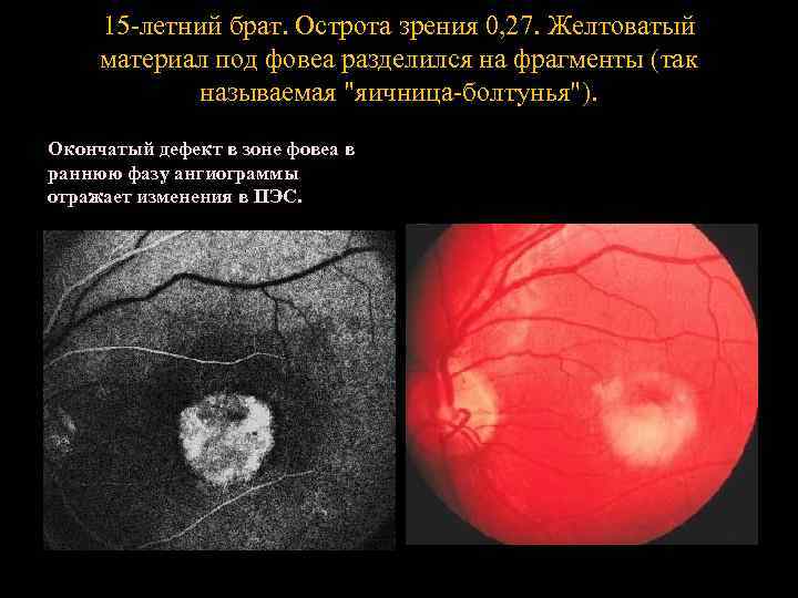 15 -летний брат. Острота зрения 0, 27. Желтоватый материал под фовеа разделился на фрагменты