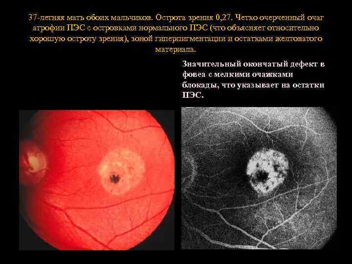 37 -летняя мать обоих мальчиков. Острота зрения 0, 27. Четко очерченный очаг атрофии ПЭС