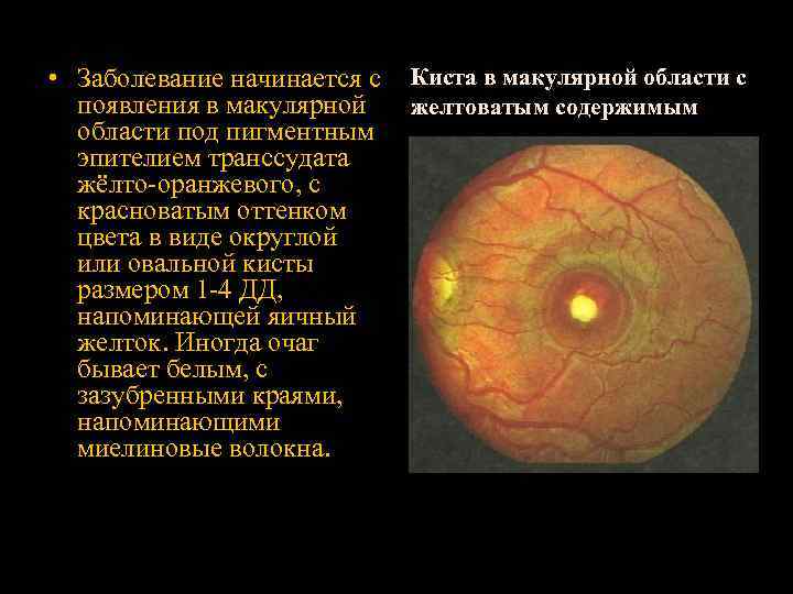  • Заболевание начинается с появления в макулярной области под пигментным эпителием транссудата жёлто-оранжевого,
