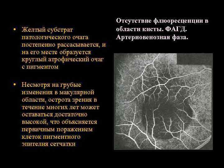  • Желтый субстрат патологического очага постепенно рассасывается, и на его месте образуется круглый