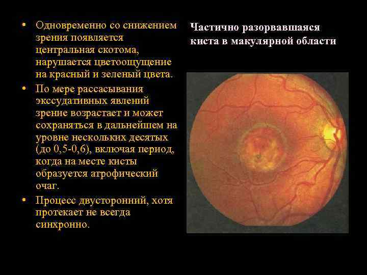  • Одновременно со снижением зрения появляется центральная скотома, нарушается цветоощущение на красный и