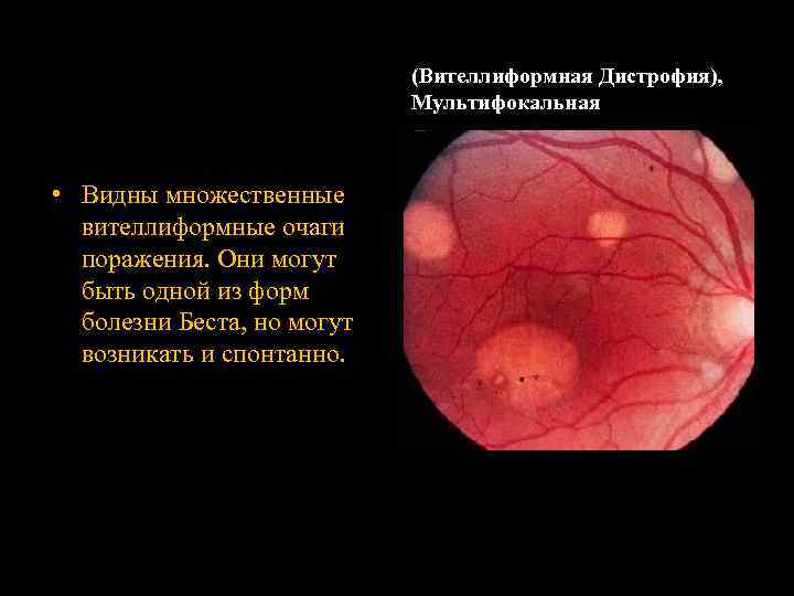 (Вителлиформная Дистрофия), Мультифокальная • Видны множественные вителлиформные очаги поражения. Они могут быть одной из