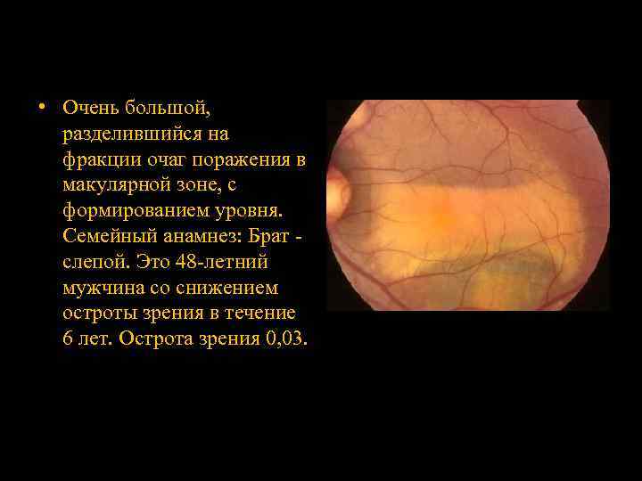  • Очень большой, разделившийся на фракции очаг поражения в макулярной зоне, с формированием