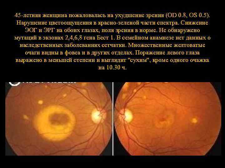 45 -летняя женщина пожаловалась на ухудшение зрения (OD 0. 8, OS 0. 5). Нарушение