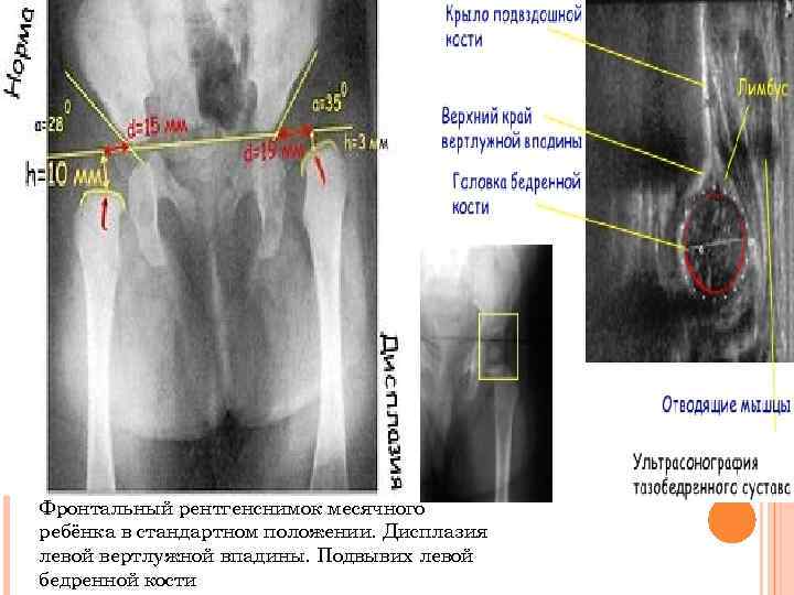 Фронтальный рентгенснимок месячного ребёнка в стандартном положении. Дисплазия левой вертлужной впадины. Подвывих левой бедренной