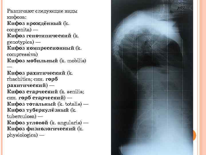 Различают следующие виды кифоза: Кифоз врождённый (k. congenita) — Кифоз генотипический (k. genotypica) —