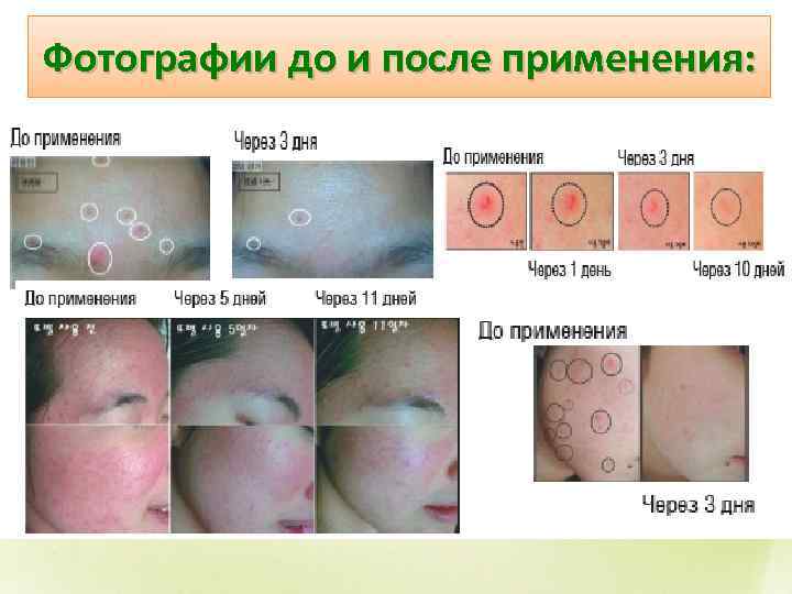 Фотографии до и после применения: 