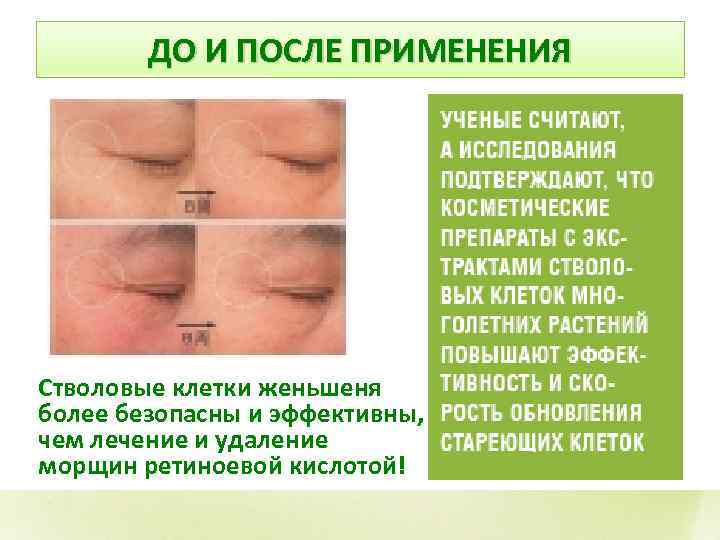 ДО И ПОСЛЕ ПРИМЕНЕНИЯ Стволовые клетки женьшеня более безопасны и эффективны, чем лечение и