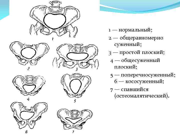 Клинический узкий таз презентация