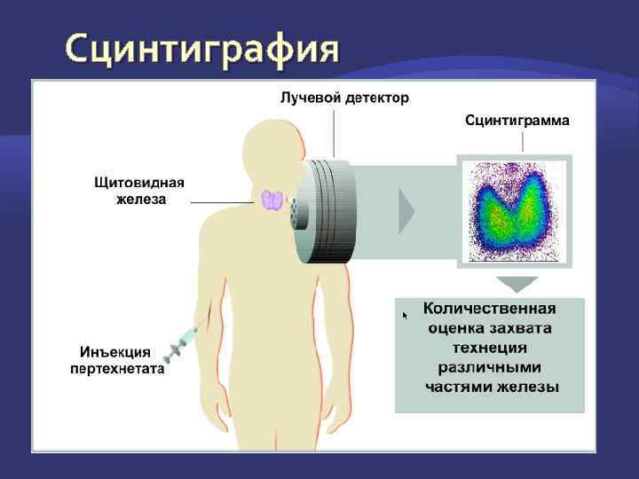 Сцинтиграфия 