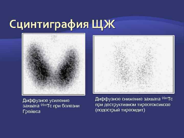 Усиление сосудистого рисунка щитовидной железы - 82 фото