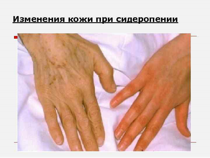 Изменения кожи при сидеропении 