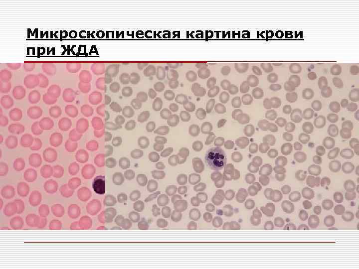 Картина крови при аллергии