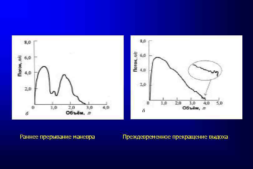 Раннее прерывание маневра Преждевременное прекращение выдоха 