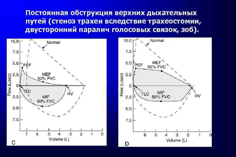 Постоянная обструкция верхних дыхательных путей (стеноз трахеи вследствие трахеостомии, двусторонний паралич голосовых связок, зоб).