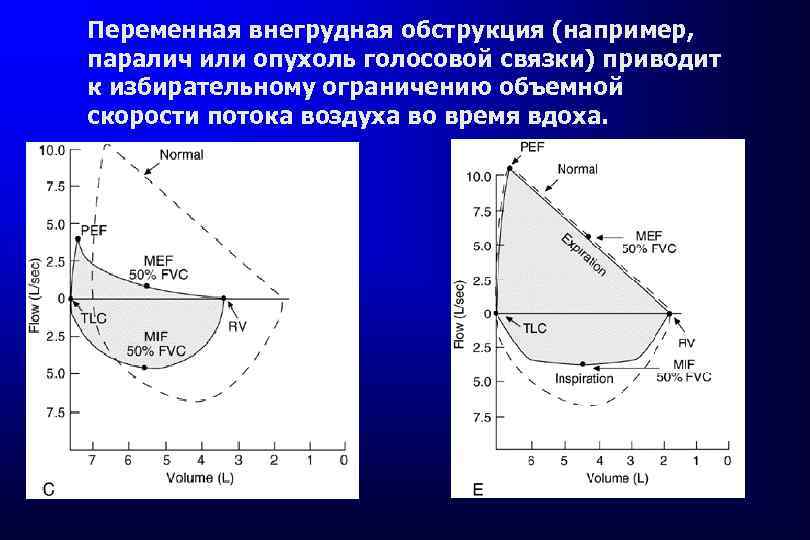 Переменная внегрудная обструкция (например, паралич или опухоль голосовой связки) приводит к избирательному ограничению объемной