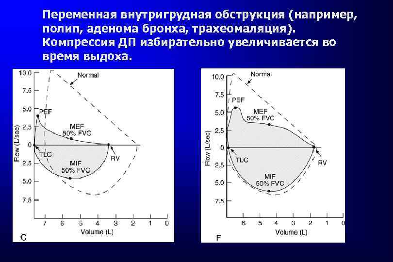 Переменная внутригрудная обструкция (например, полип, аденома бронха, трахеомаляция). Компрессия ДП избирательно увеличивается во время