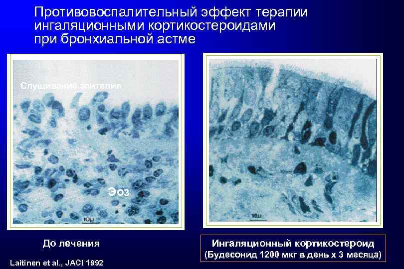 Противовоспалительный эффект терапии ингаляционными кортикостероидами при бронхиальной астме Слущивание эпителия Эоз До лечения Laitinen