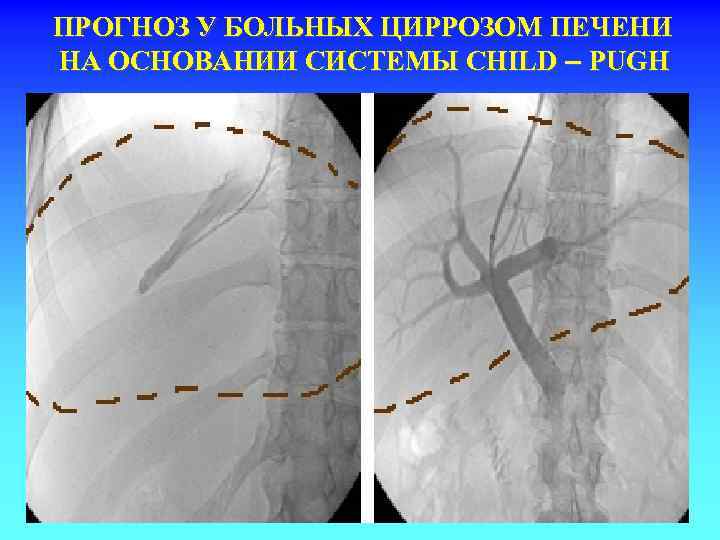 ПРОГНОЗ У БОЛЬНЫХ ЦИРРОЗОМ ПЕЧЕНИ НА ОСНОВАНИИ СИСТЕМЫ CHILD – PUGH 