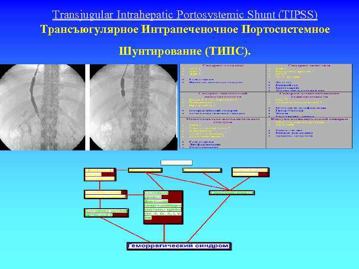 Transjugular Intrahepatic Portosystemiс Shunt (TIPSS) Трансъюгулярное Интрапеченочное Портосистемное Шунтирование (ТИПС). 