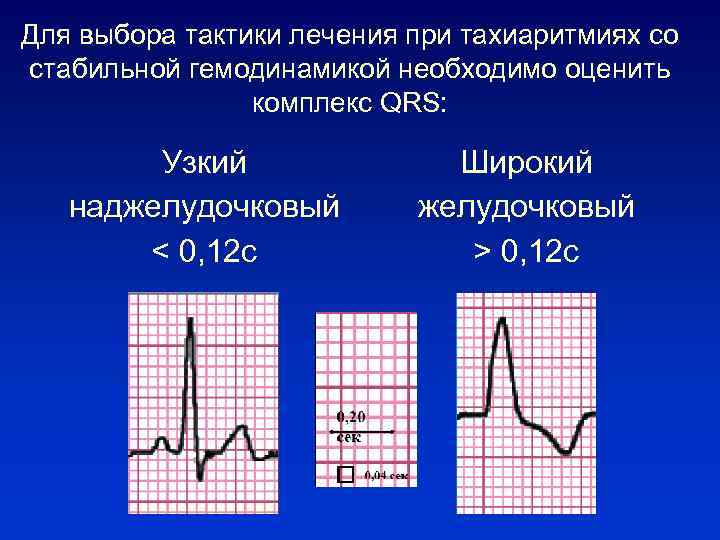 Для выбора тактики лечения при тахиаритмиях со стабильной гемодинамикой необходимо оценить комплекс QRS: Узкий