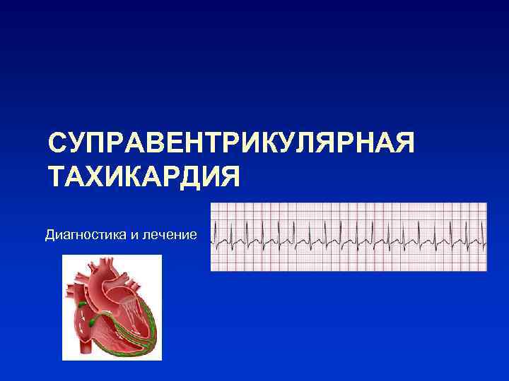 СУПРАВЕНТРИКУЛЯРНАЯ ТАХИКАРДИЯ Диагностика и лечение 