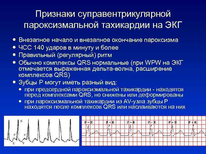 Признаки суправентрикулярной пароксизмальной тахикардии на ЭКГ Внезапное начало и внезапное окончание пароксизма ЧСС 140