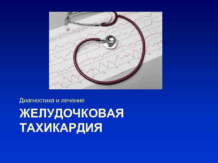 Диагностика и лечение ЖЕЛУДОЧКОВАЯ ТАХИКАРДИЯ 