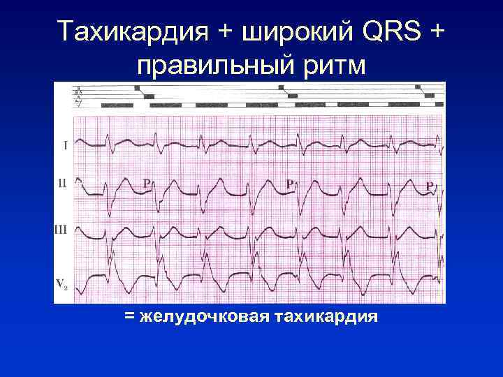 Тахикардия + широкий QRS + правильный ритм = желудочковая тахикардия 