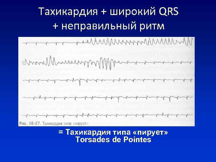 Тахикардия + широкий QRS + неправильный ритм = Тахикардия типа «пирует» Torsades de Pointes