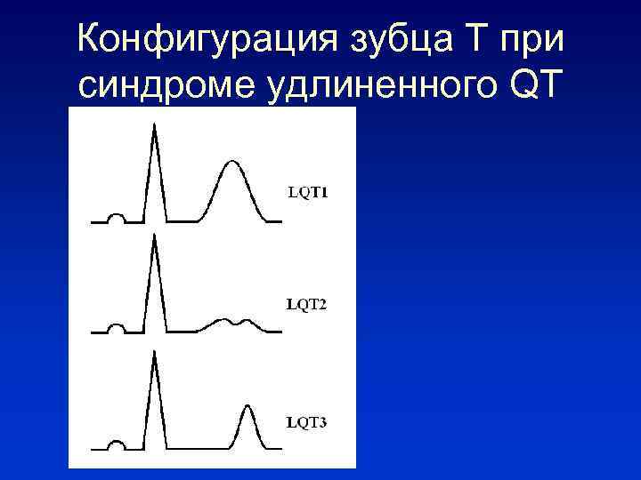 Удлиненное qt у ребенка. Синдром удлиненного интервала qt на ЭКГ. ЭКГ С синдромом удлиненного интервала qt у детей. Синдром удлиненного интервала q-t. Удлинение интервала qt.