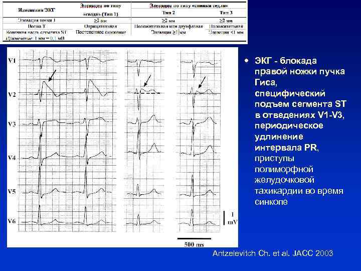 Подъем st. ЭКГ элевация сегмента St в 1 отведении v1-6. Подъем St на ЭКГ В v1 v3. Подъем St на ЭКГ v1-v2. ЭКГ подъем St v2 v3.