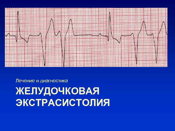 Лечение и диагностика ЖЕЛУДОЧКОВАЯ ЭКСТРАСИСТОЛИЯ 