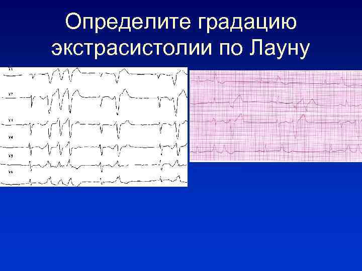 Определите градацию экстрасистолии по Лауну 