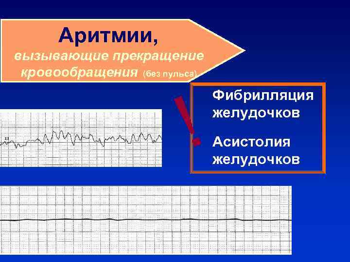Аритмии, вызывающие прекращение кровообращения (без пульса) ! Фибрилляция желудочков Асистолия желудочков 